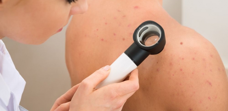 Câncer de pele: confira 4 dicas para se prevenir!
