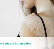 Vitiligo: Sintomas, causas e tratamentos