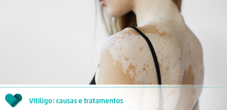 Vitiligo: Sintomas, causas e tratamentos